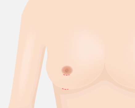 胸部修复术 胸部修复术,胸部手术,包膜挛缩,假体破裂,胸部不对称