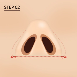 鼻翼缩小 鼻翼缩小,缩鼻翼手术,鼻孔宽大,福鼻,隆鼻整形