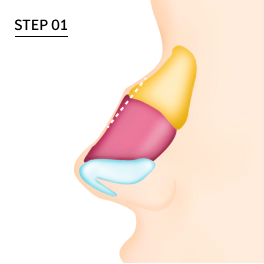 驼峰鼻矫正 驼峰鼻矫正,驼峰鼻,鼻部整形,去除驼峰鼻,驼峰鼻整形