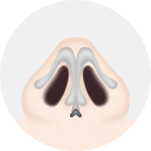 麦恩鼻部整形 麦恩鼻部整形,鼻部整形,鼻尖整形,福鼻,鼻翼缩小