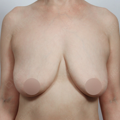 胸部缩小 胸部缩小,缩胸手术,胸部下垂,巨乳,胸部手术