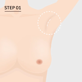 胸部修复术 胸部修复术,胸部手术,包膜挛缩,假体破裂,胸部不对称