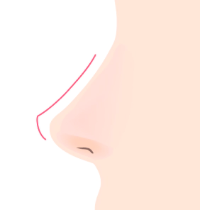 鼻尖整形 鼻尖整形,鼻尖整形后记,鼻尖整形费用,鼻尖整形前后,鼻尖整形副作用