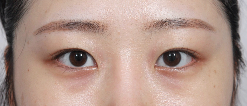 眼睑下垂 眼型矫正 眼型矫正 眼睑下垂,眼睑下垂,双眼皮提肌,眼型矫正价格,眼型矫正副作用