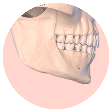 下颌角手术 下颌角手术,下颌角整形,面部轮廓改善,面部轮廓整形,下颌线