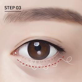 眼底脂肪重置 眼底脂肪重置,黑眼圈消除方法,黑眼圈,黑眼圈遮瑕,眼底脂肪重置手术
