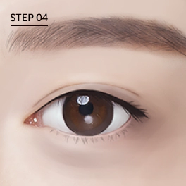 眼底脂肪重置 眼底脂肪重置,黑眼圈消除方法,黑眼圈,黑眼圈遮瑕,眼底脂肪重置手术