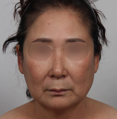 面部拉皮 面部拉皮,面部拉皮副作用,面部拉皮案例,面部拉皮手术费,面部拉皮疤痕