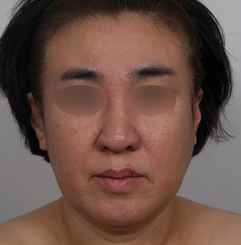 面部拉皮 面部拉皮,面部拉皮副作用,面部拉皮案例,面部拉皮手术费,面部拉皮疤痕
