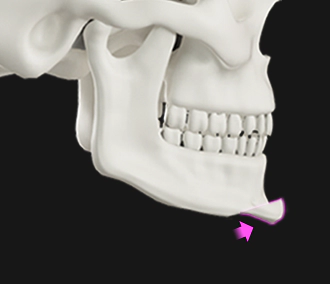 下巴手术 下巴手术,下巴整形,面部轮廓,下颌线,下巴缩小