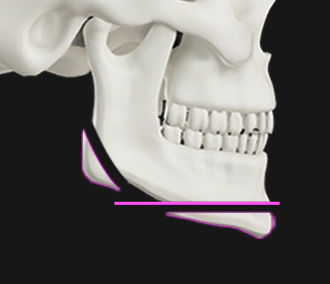 下巴手术 下巴手术,下巴整形,面部轮廓,下颌线,下巴缩小