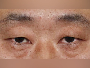 中年眼部整形 上眼睑,上眼睑手术,上眼睑手术费用,上眼睑手术恢复期,上眼睑手术案例