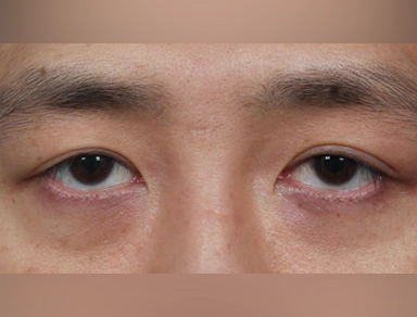 中年眼部整形 上眼睑,上眼睑手术,上眼睑手术费用,上眼睑手术恢复期,上眼睑手术案例