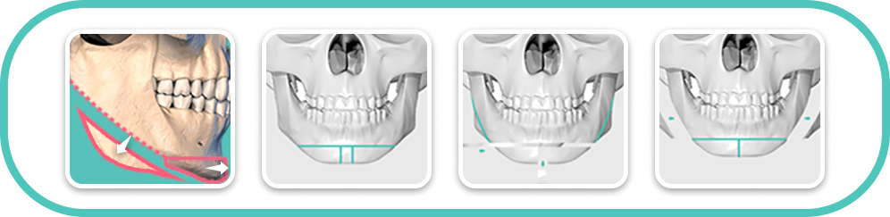 下颌角手术 下颌角手术,下颌角整形,面部轮廓改善,面部轮廓整形,下颌线