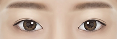 男士眼部修复术 男士眼部修复,男士眼部整形,男士眼部手术,男士整形,男士眼部整形副作用
