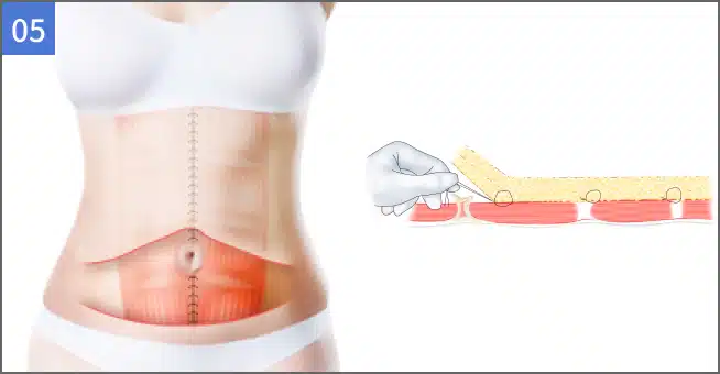 作为腹部整形的重要部分，利用progressive tension sutures实现无副作用的腹部缝合.