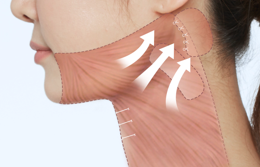 拉伸阔颈肌包裹下巴进行颈部拉皮的方法.