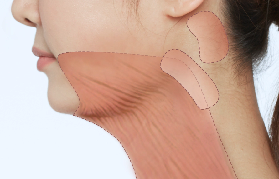 颈部拉皮时剥离后确定颈阔肌和固定部位.