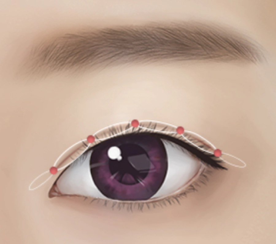 男性眼部整形用双重结法打造不显眼的方法.