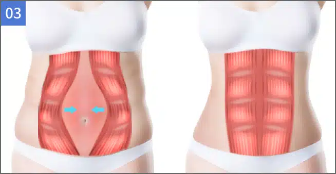 将下垂的腹肌拉到中间缝合，打造出苗条腹型的腹部整形方法.