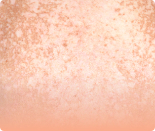 发生在整个脸部的色素沉着。