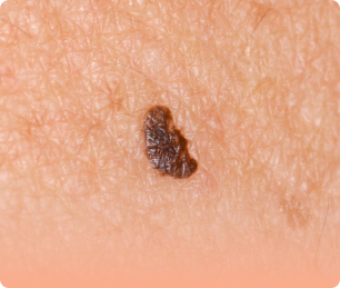 面部产生的大片黑斑痣。