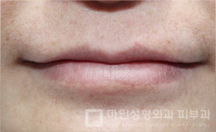 玻尿酸丰唇&嘴角肉毒 玻尿酸丰唇,玻尿酸丰唇前后,玻尿酸,肉毒素,嘴唇
