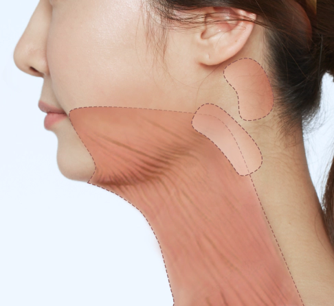 颈部拉皮时提拉颈阔肌前的位置.