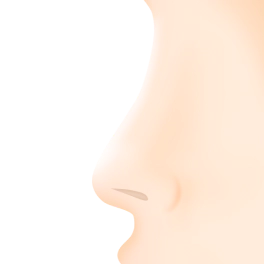 矮鼻矫正 矮鼻矫正,鼻部整形,鼻尖整形,鼻子假体,鼻整形