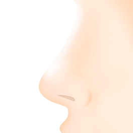 矮鼻矫正 矮鼻矫正,鼻部整形,鼻尖整形,鼻子假体,鼻整形