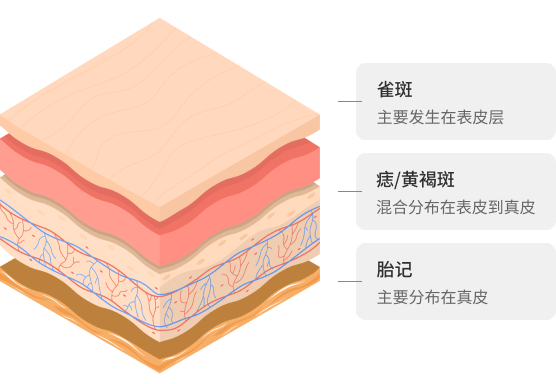 通过色素治疗有效改善黄褐斑、雀斑、混合斑等色素疾病.