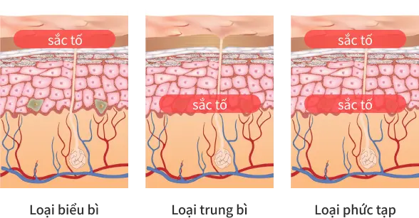 彻底去除色素，预防复发.