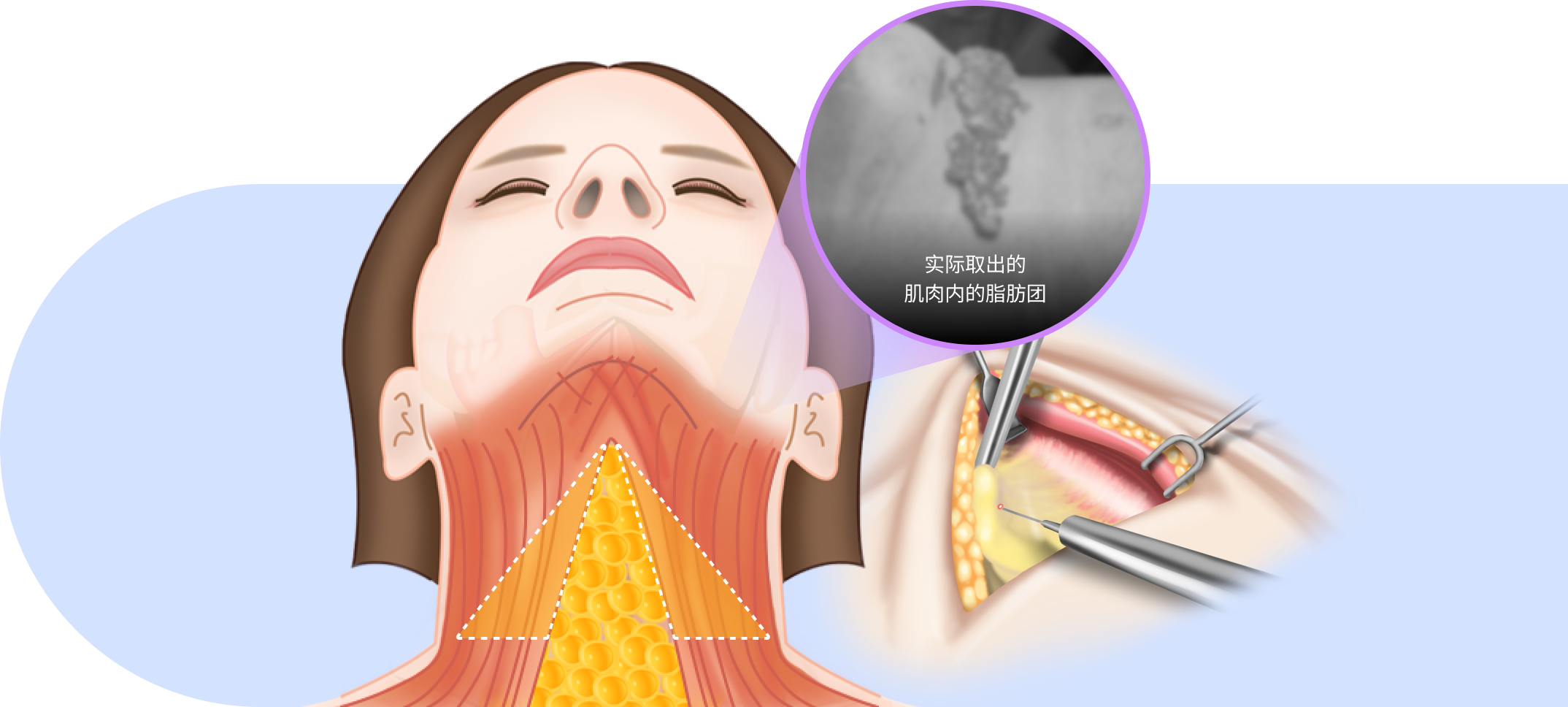 通过熟练的专业技术稳定去除肌肉内的脂肪块,提高下巴下方改善效果.