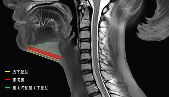 MRI影像下去除肌肉内侧脂肪团.