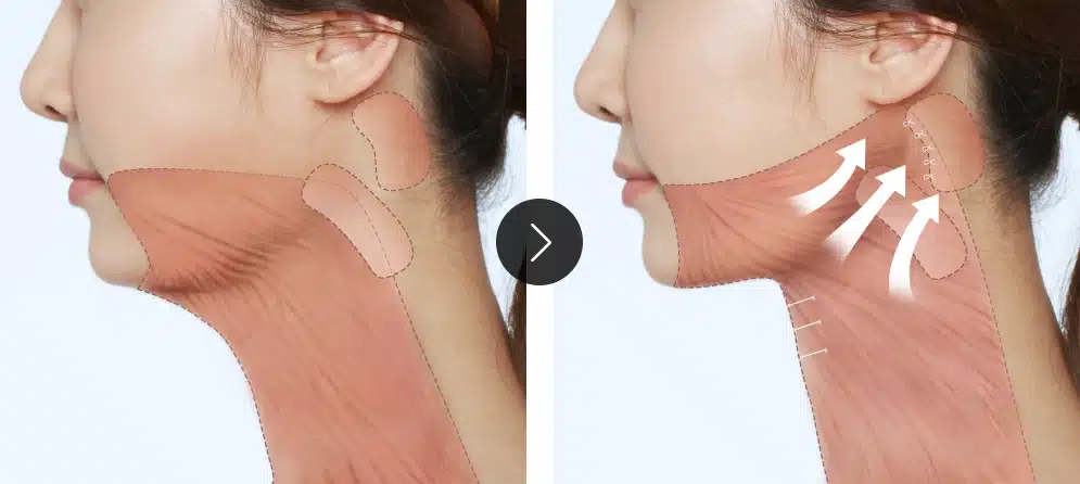 颈部皱纹和下颌线同时改善的领先技术，颈部拉皮手术成就非凡塑美颈部