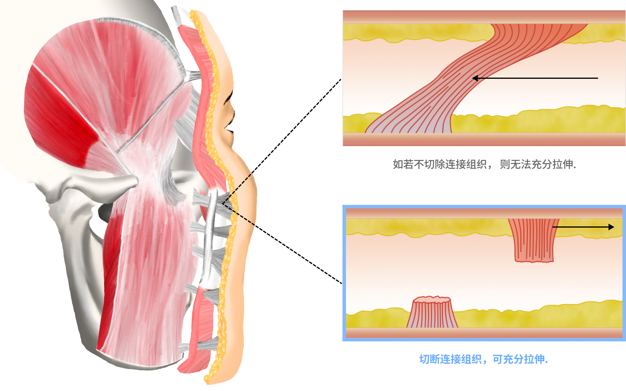 面部颈部拉皮 面部颈部拉皮,面部拉皮,颈部拉皮,面部拉皮后记,面部拉皮副作用