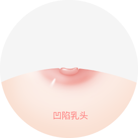 乳头凹陷图。