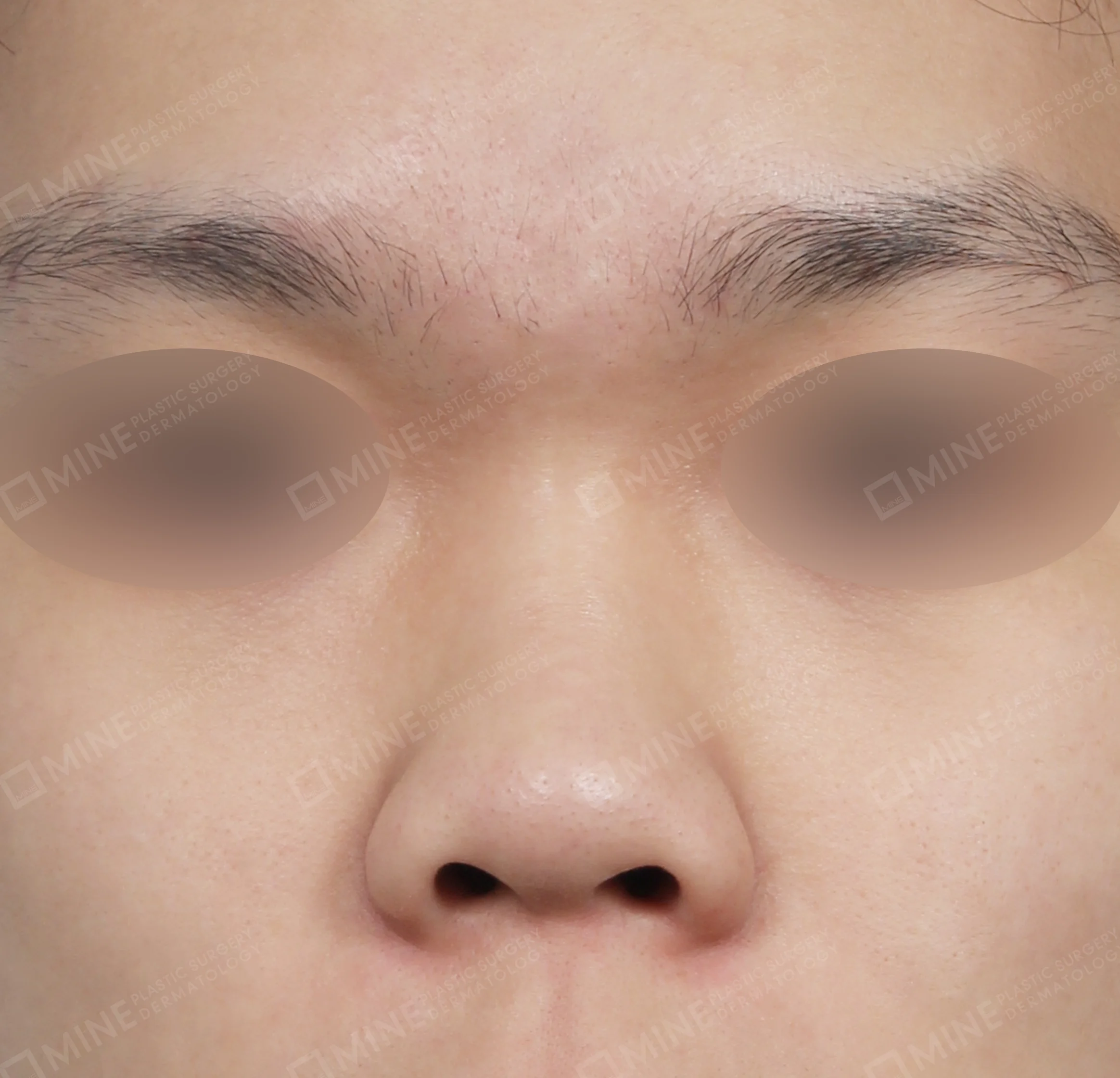 驼峰鼻 + 鼻梁 + 鼻中隔延长 + 缩鼻尖-정면-전