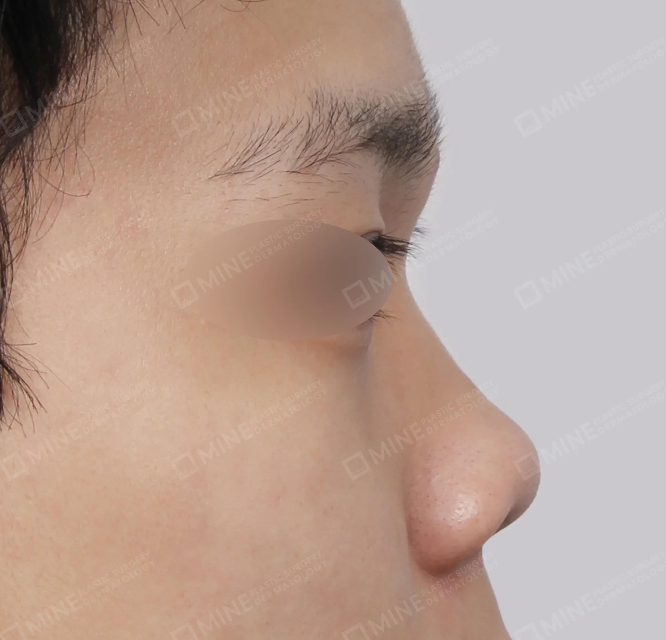 驼峰鼻 + 鼻梁 + 鼻中隔延长 + 缩鼻尖-측면-전