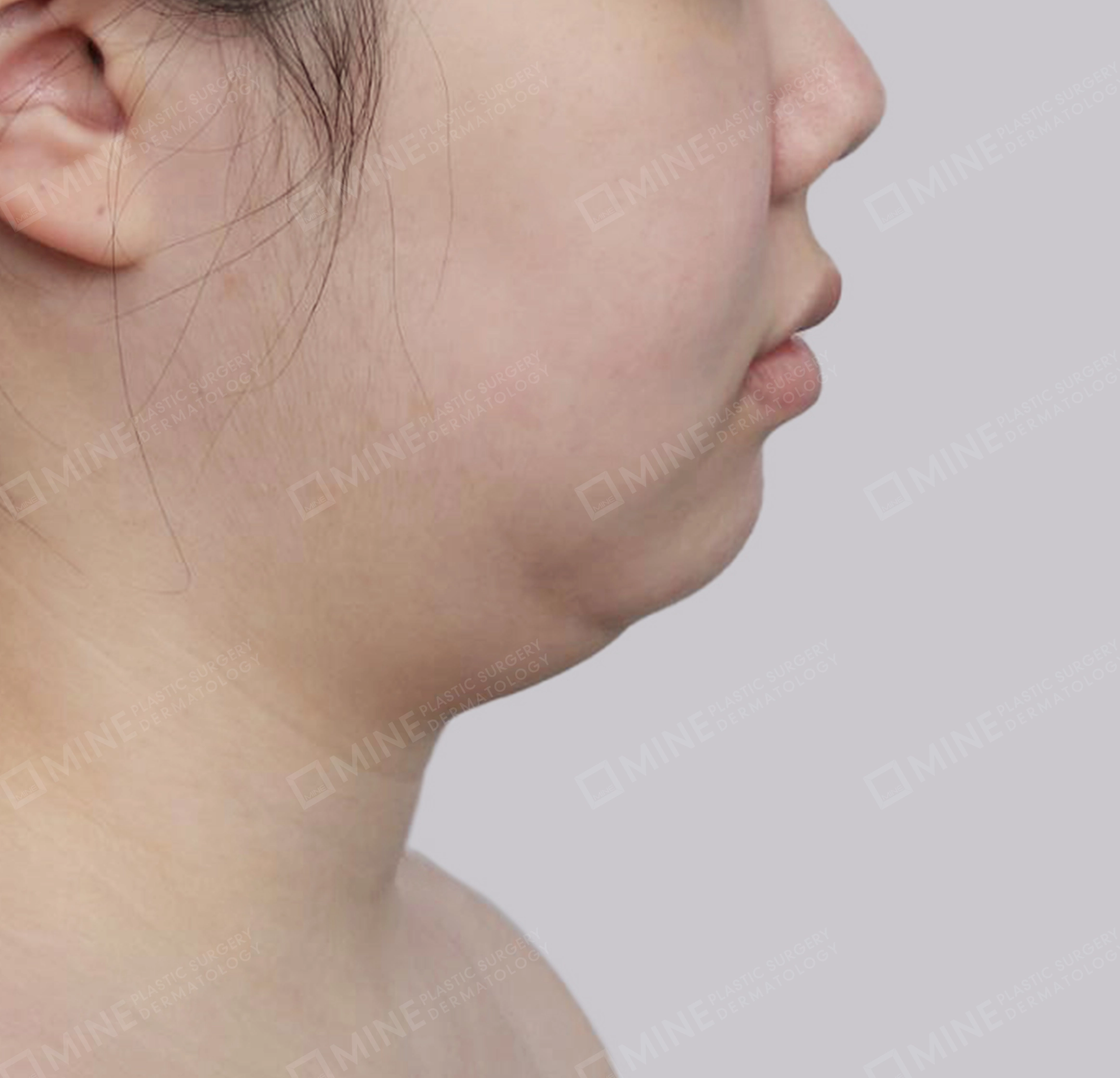 迷你颈部拉皮-측면-전