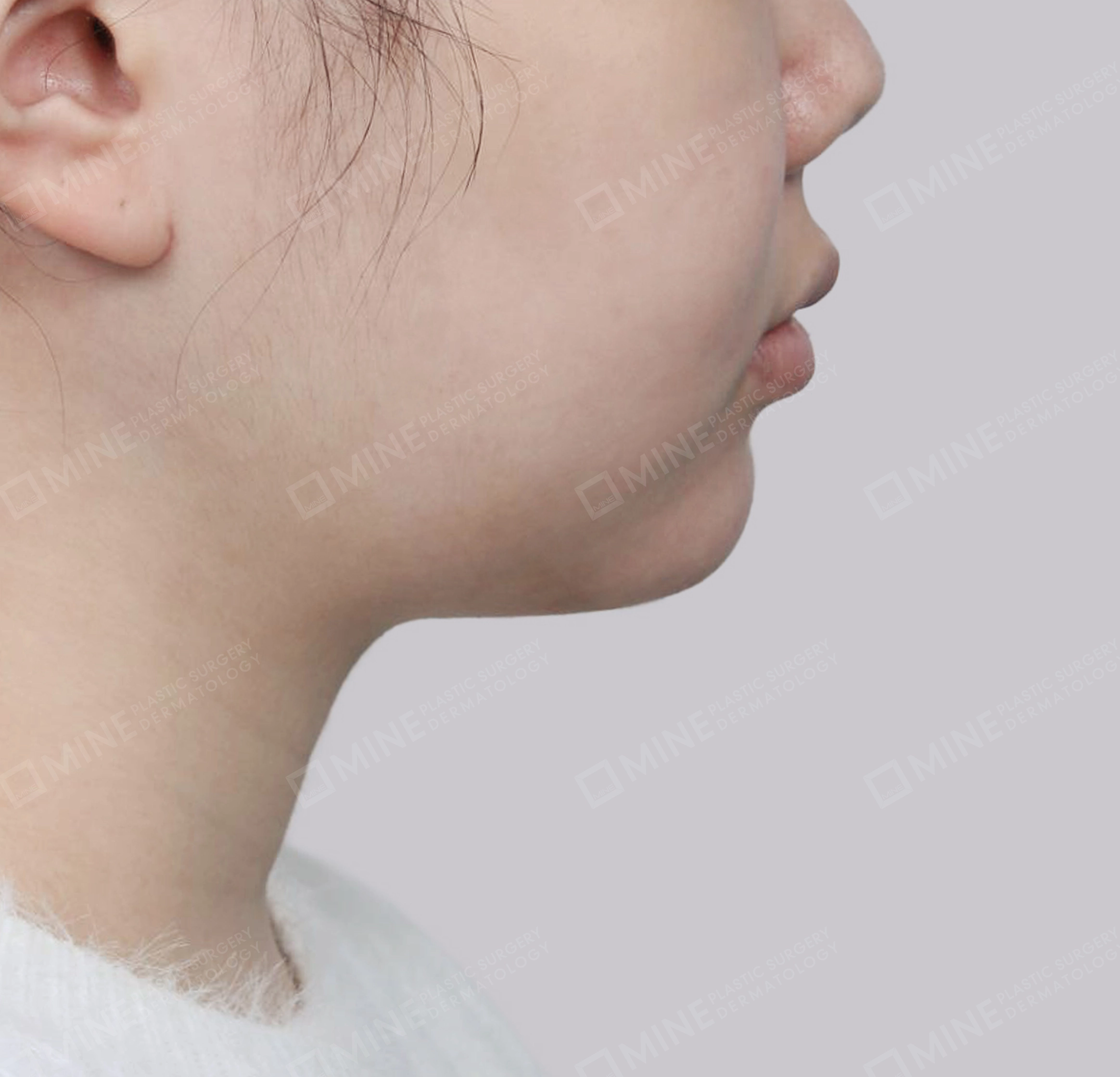 迷你颈部拉皮-측면-후