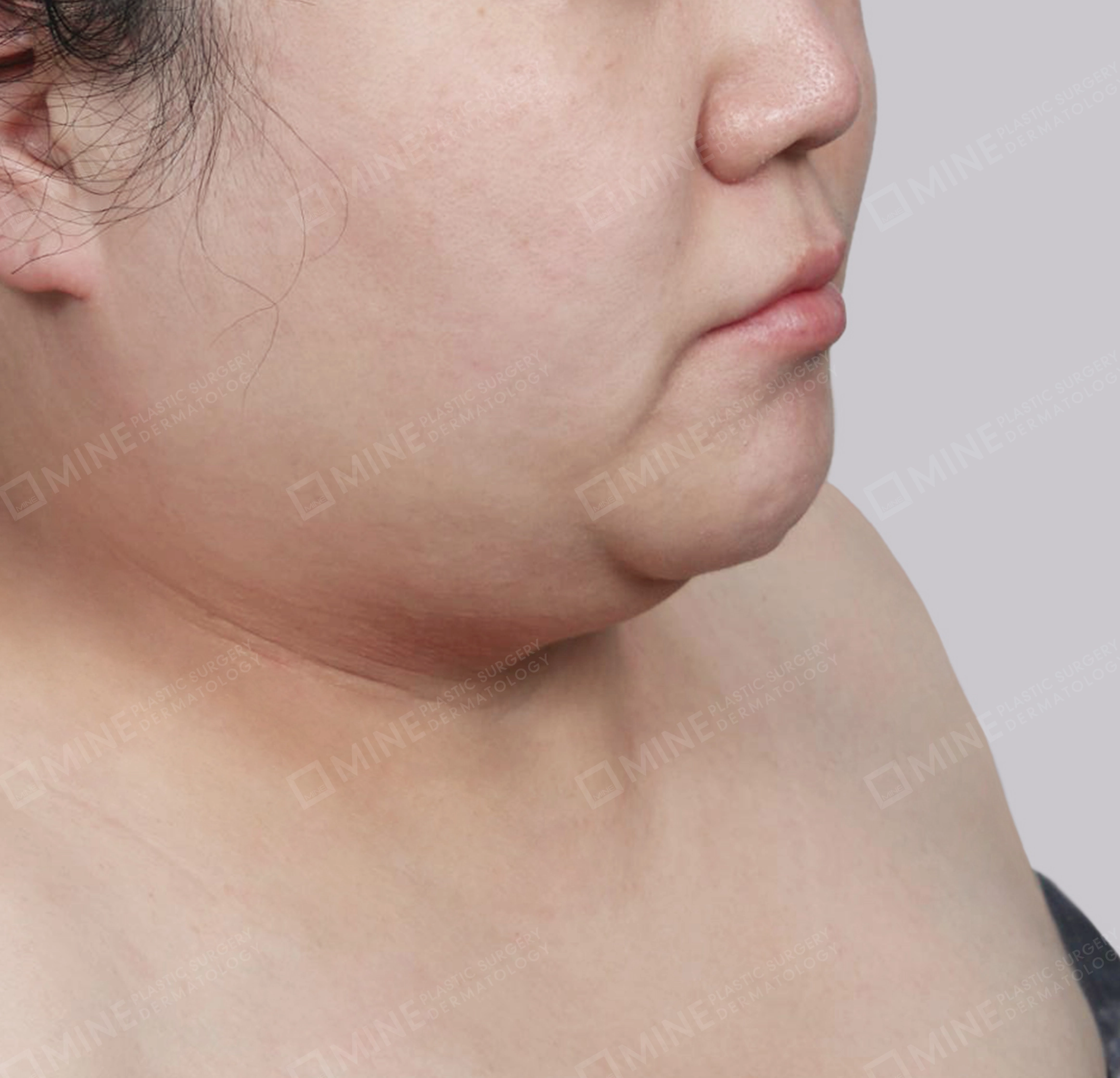 迷你颈部拉皮-정면-전