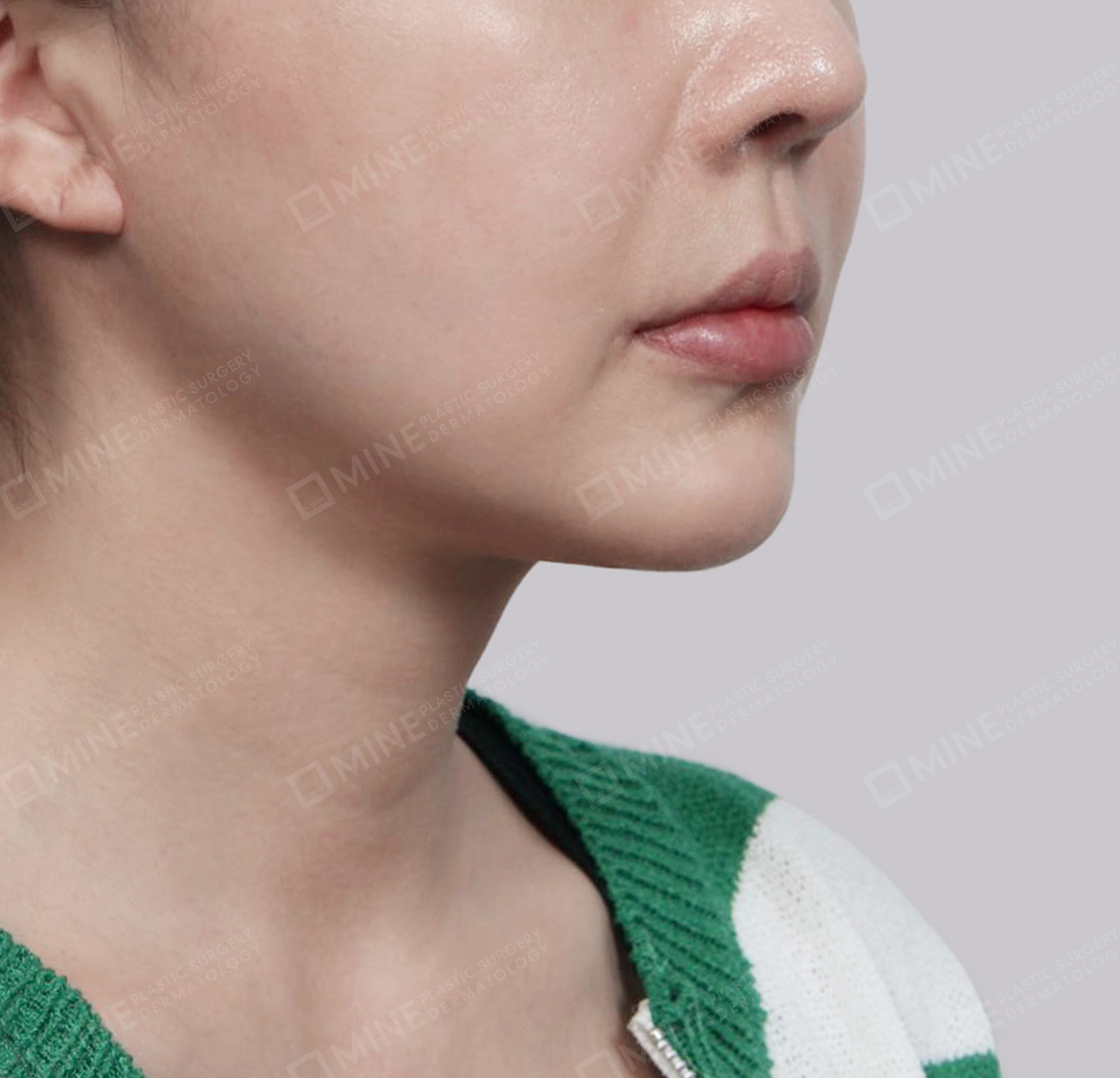 迷你颈部拉皮-정면-후