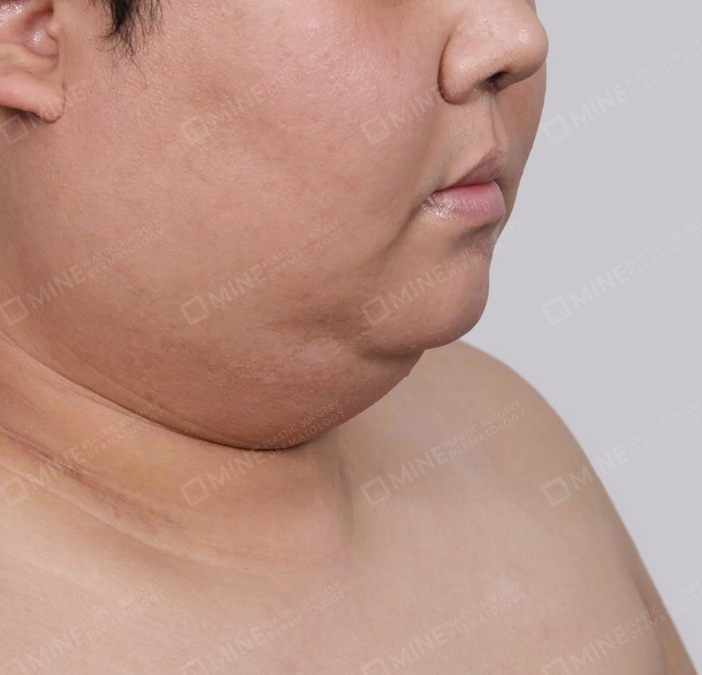 迷你颈部拉皮-정면-전