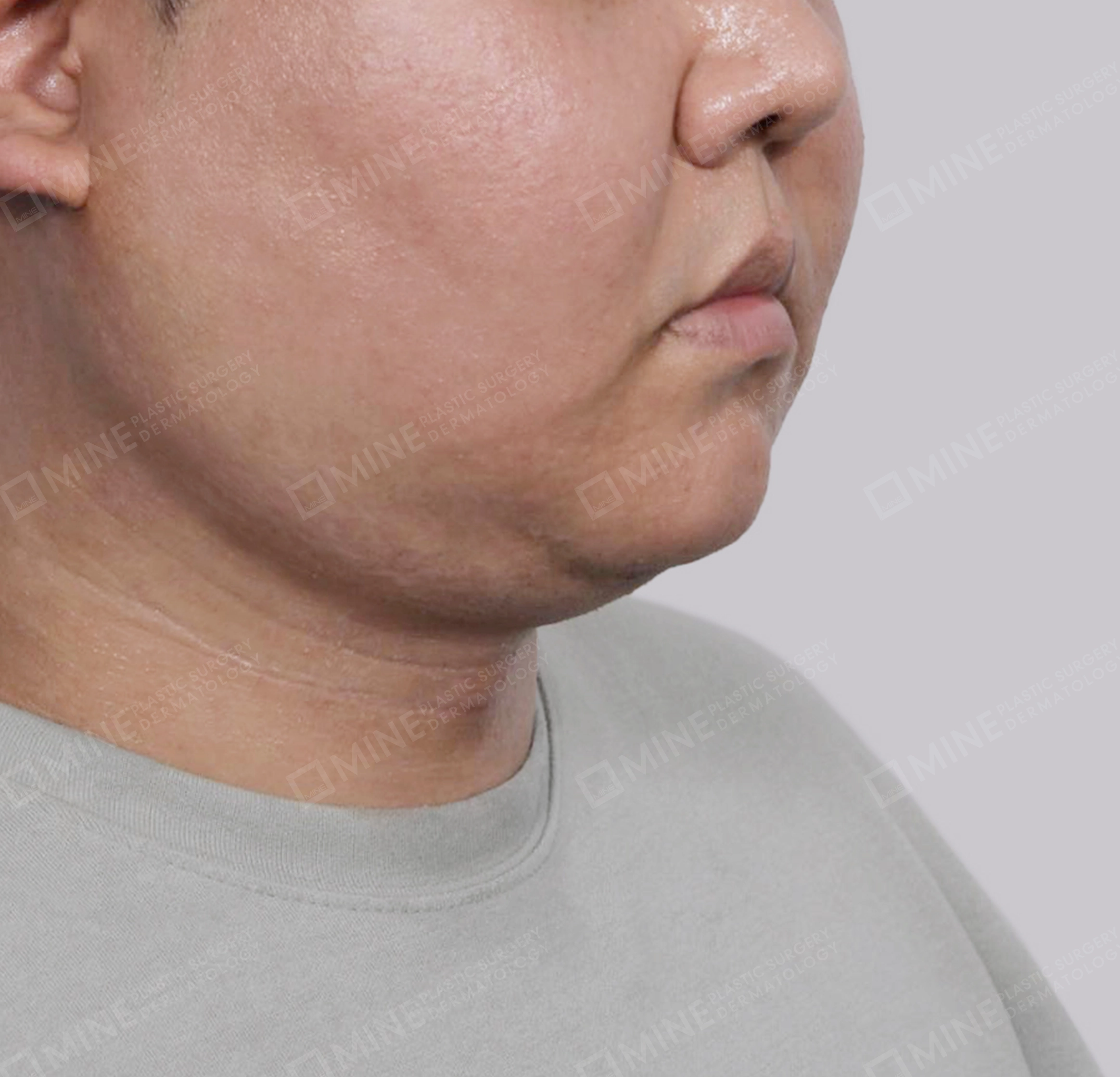 迷你颈部拉皮-정면-후