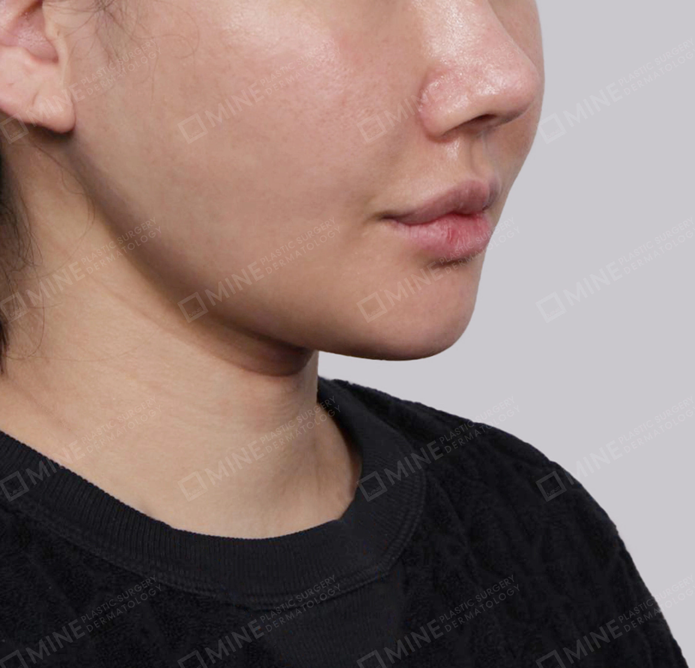 迷你颈部拉皮-정면-후