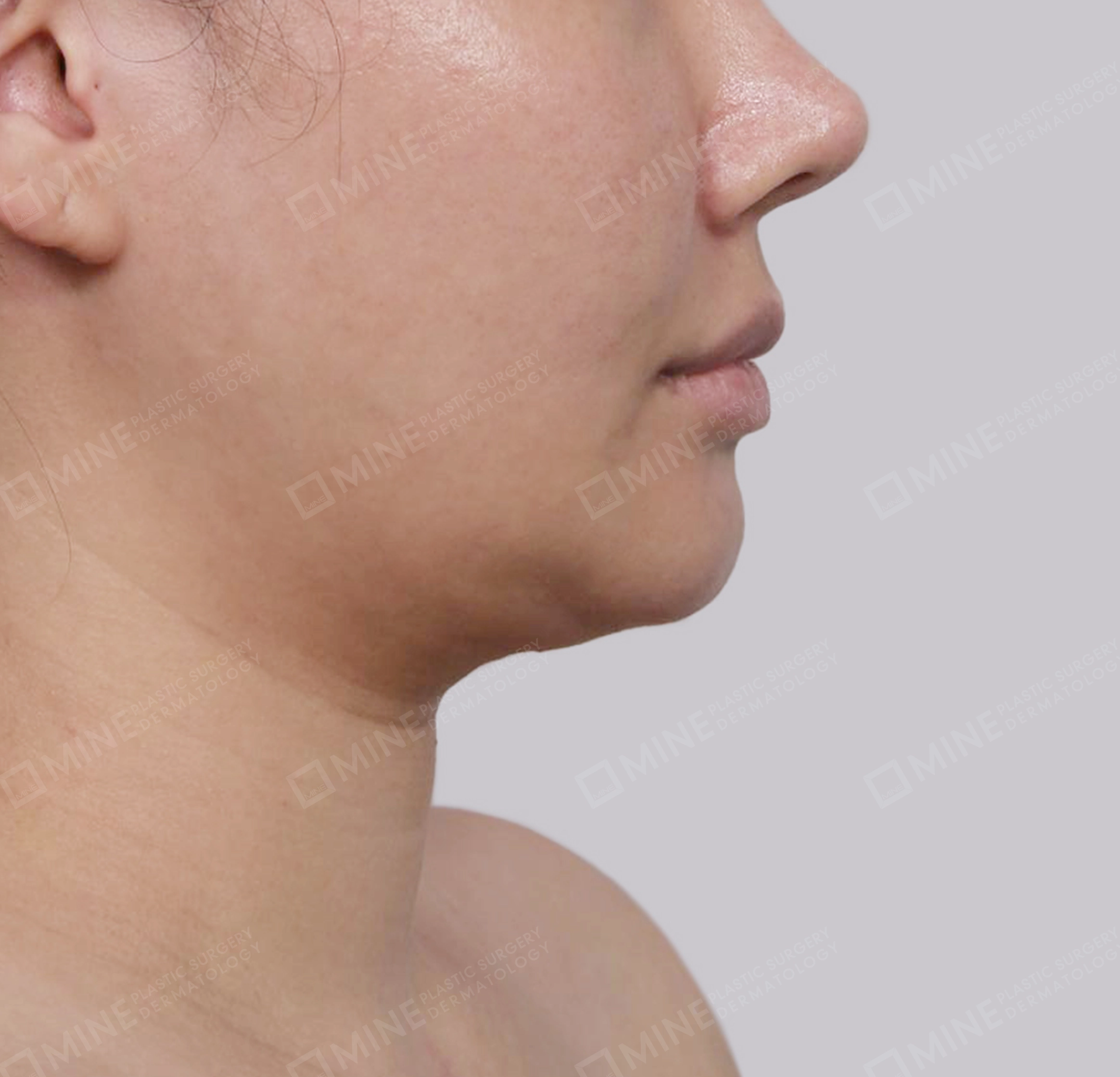 迷你颈部拉皮-측면-전