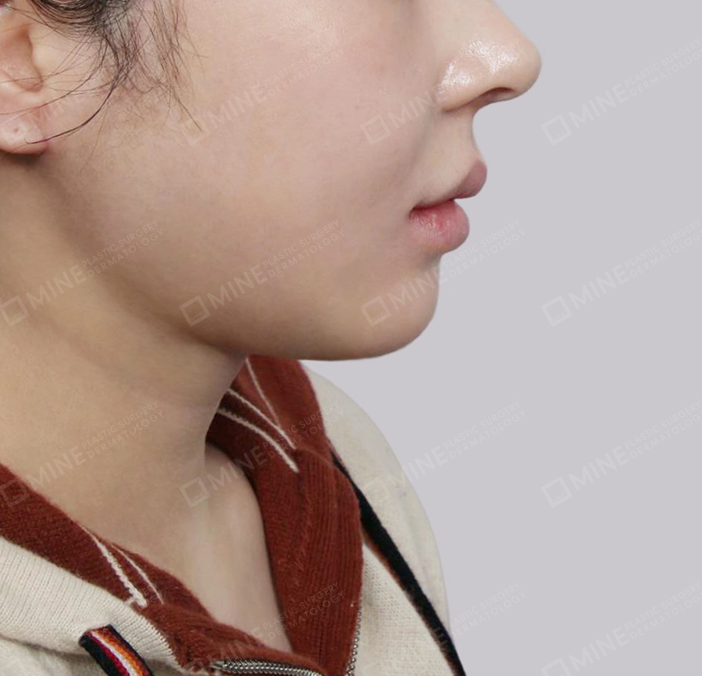 迷你颈部拉皮-측면-후