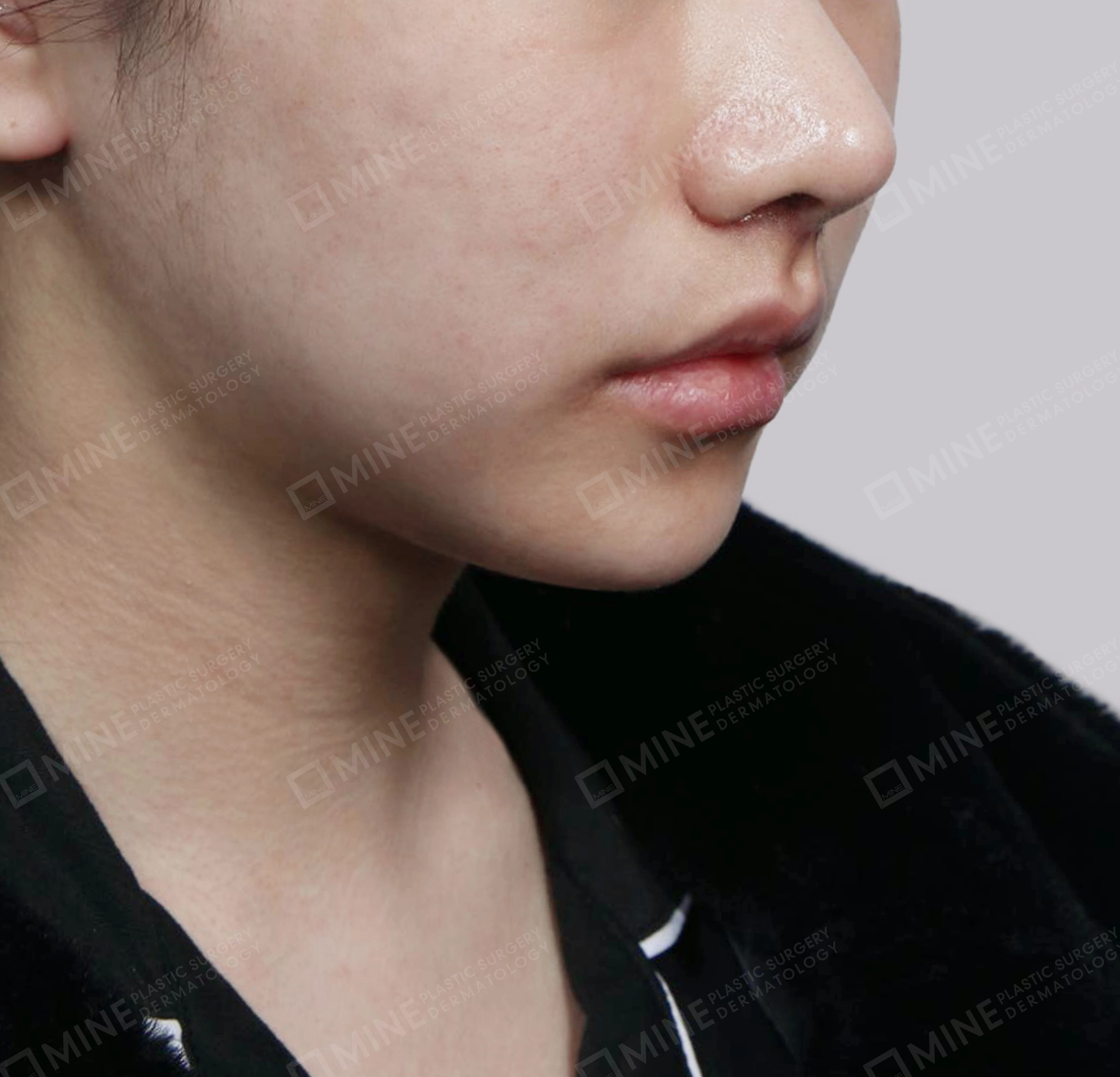 迷你颈部拉皮-정면-후