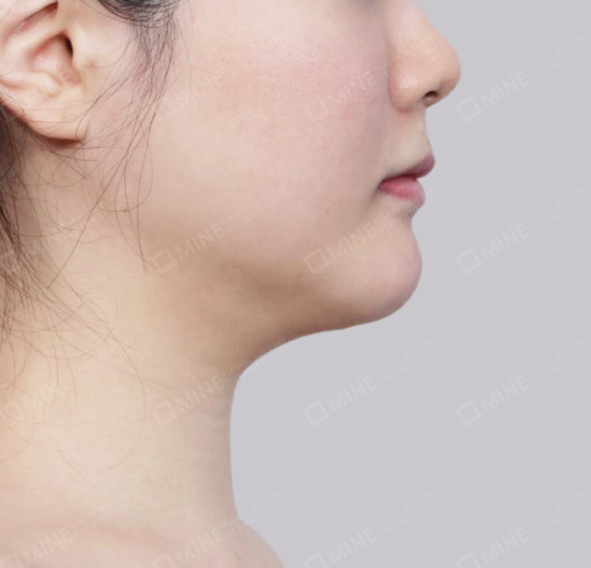 双下巴唾液腺去除-측면-전